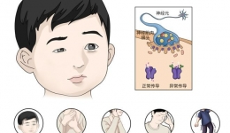 孩子眼睛一大一小，睡一觉又恢复？别把“神经求救信号”当疲劳！