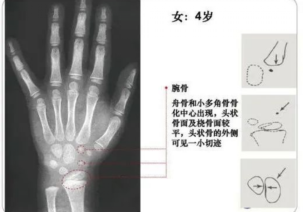 9岁女孩来月经，预测成年身高仅141cm！出现这些情况，真的有必要测骨龄