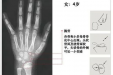 9岁女孩来月经，预测成年身高仅141cm！出现这些情况，真的有必要测骨龄