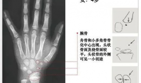 9岁女孩来月经，预测成年身高仅141cm！出现这些情况，真的有必要测骨龄
