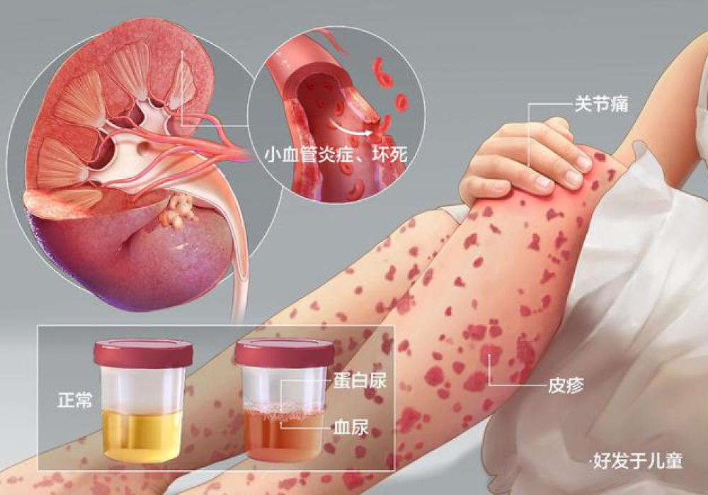看看孩子身上是否有这种出血点！要警惕……