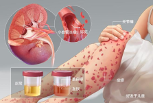 看看孩子身上是否有这种出血点！要警惕……